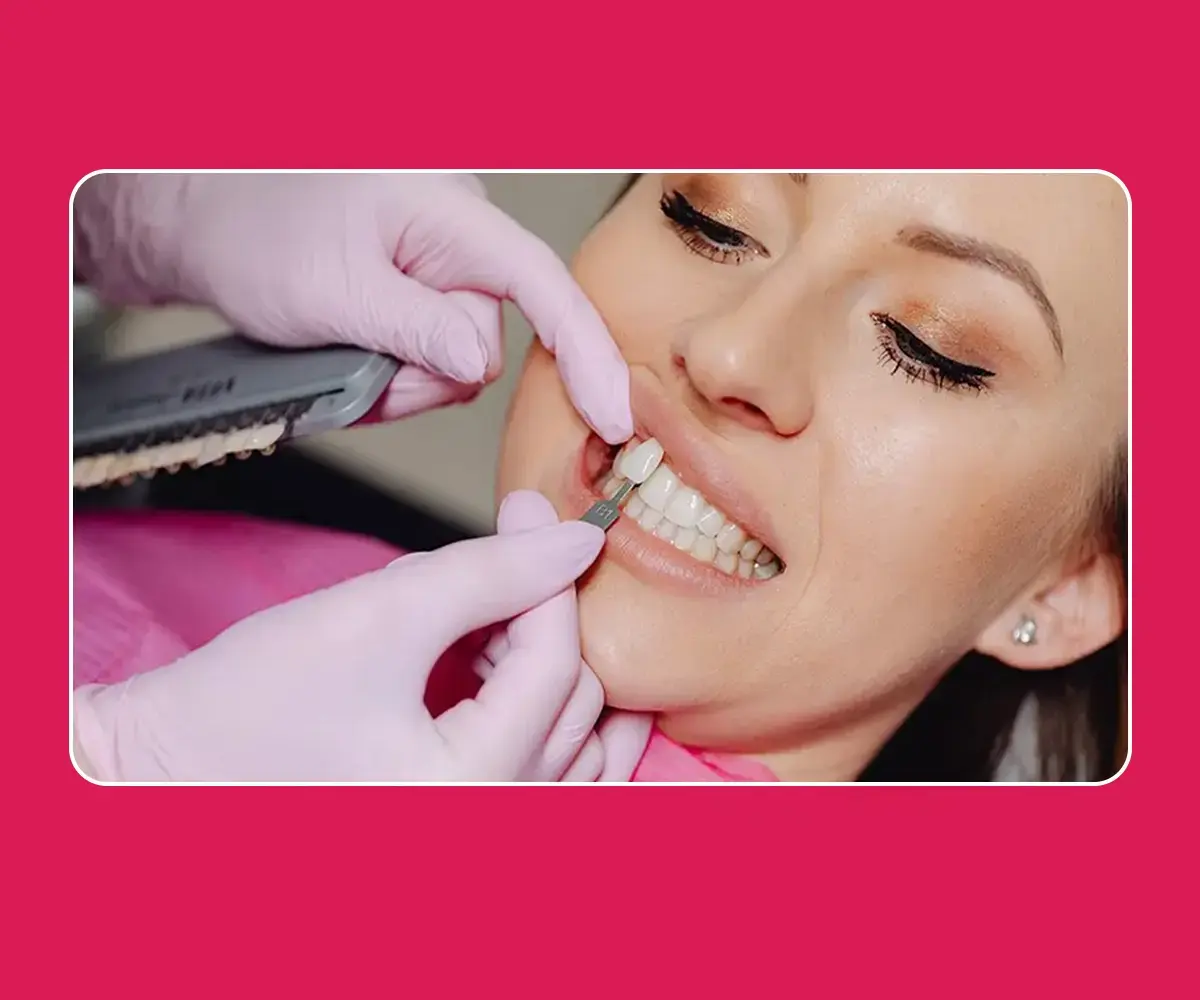 Dental Veneers in Gurgaon